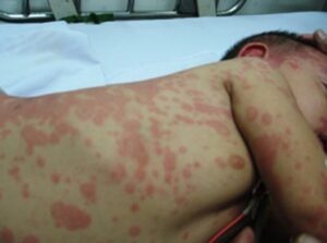 Nhận Biết Dấu Hiệu Bệnh Não Mô Cầu và Các Biện Pháp Phòng Ngừa