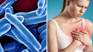 Hướng Dẫn Hiểu Biết Về Bệnh Lao Vú: Điều Trị, Chăm Sóc và Nhận Thức