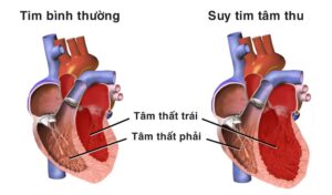 Cảnh Tỉnh Nguy Hiểm: Suy Tim Ở Tuổi 35