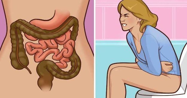5 Dấu Hiệu Cảnh Báo Ung Thư Đại Trực Tràng Ở Người Trẻ