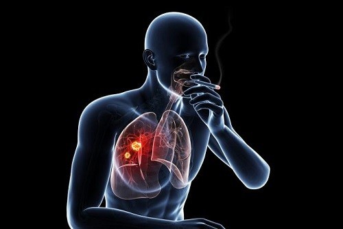 90% Ca Ung Thư Phổi Do Hút Thuốc: Nguy Cơ và Cách Phát Hiện Sớm